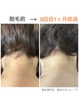 レーヴ/全身脱毛にうなじ脱毛付き☆