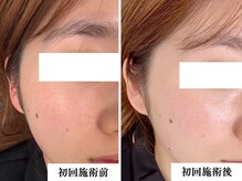 リコス(LICCO’S)/復元パック１回施術後