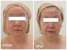 ナビ(NABI)/韓国発レモンボトル瞬間小顔