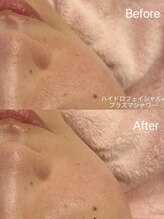 リンダ 西宮店(LINDA)/ハイドロ×プラズマ