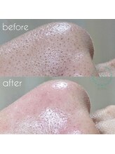 プライベートサロン コットン(COTTON)/毛穴エクストラクション