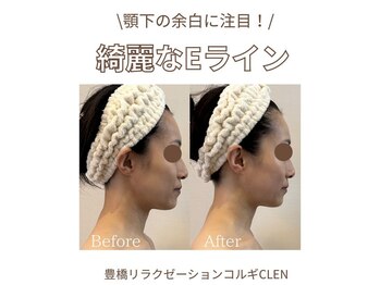 クレン(CLEN)/小顔コルギ