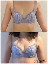 リール 新宿店(RIRE)/20代前半　バストアップ症例