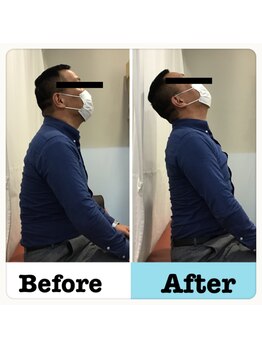 フォーユー鍼灸整骨院 津久野院(for you 鍼灸整骨院)/首の可動域への施術１