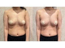 ブリア 横浜(BRILLA)/理想のバスト、叶います＊