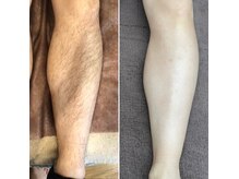 男性の濃い毛にも効果を実感男性もツルスベ肌へ