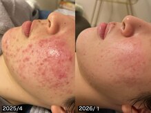 リリアス(RILLIAS)/ニキビケア