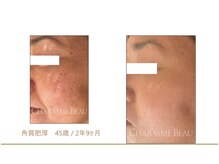 リンクアンドボーテ 大垣(Link&Beaute)/肌改善.エイジングケア