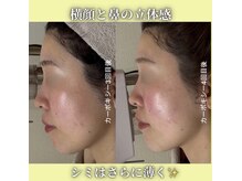 ハニエル(Haniel)/カーボキシー症例