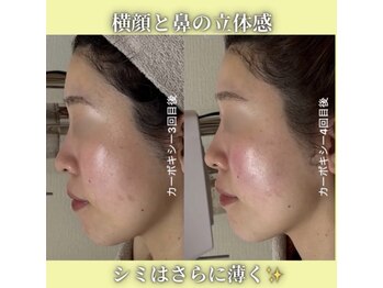 ハニエル(Haniel)/カーボキシー症例