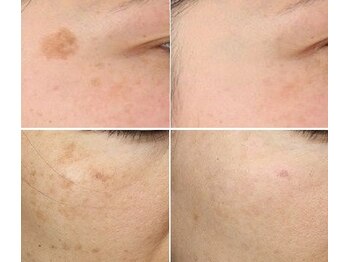 ナチュレアンドメディカ(Nature&Medica)/シミ集中ケア:数回で粉砕→剥離