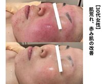 ボニータ(Bonita)/【Lit】ヒト羊膜幹細胞エステ