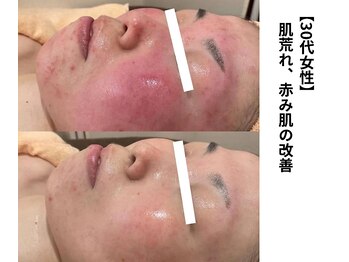 ボニータ(Bonita)/【Lit】ヒト羊膜幹細胞エステ