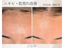 スリースリー 恵比寿(THREE THREE)/ニキビ・肌荒れケア