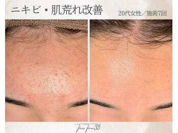 スリースリー 恵比寿(THREE THREE)/ニキビ・肌荒れケア