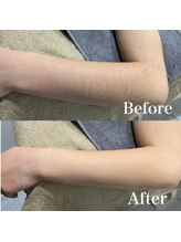 デザインファム(DESIGN FAM)/光脱毛