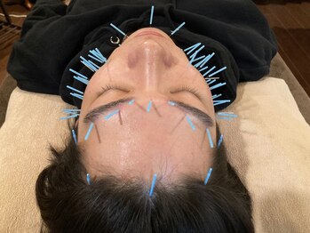 アキュティ 吉祥寺(Acuty)/メンズ小顔美容鍼