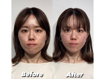 コルミチョン サロン(骨美整 salon)/Before・After(左右非対称施術)