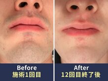 アリッサムフォーメン 岡山店(ALiSSUM for men)/1回目→12回目