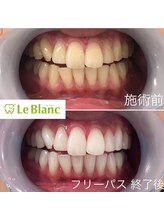 ルブラン 奈良店(Le Blanc)/白い歯っていいね！！