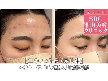 ボディアーキ 吉祥寺店(BODY ARCHI)/【ニキビ/シミ/赤ら顔】肌質改善