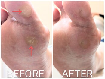 リヴィエール(Riviere)/50代女性　タコ、魚の目の痛み