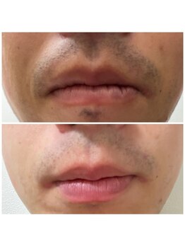 メンズ脱毛＆ヘッドスパ MEN'S with Lilina. 新横浜［ヒゲ脱毛/全身脱毛/VIO脱毛］/ヒゲ脱毛3回　最新LEDメンズ脱毛