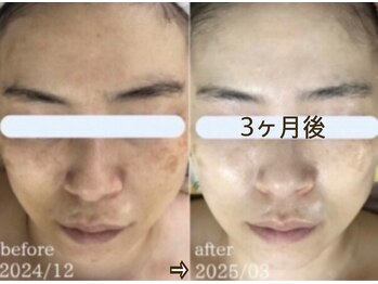 アルページュ(Arpege)の写真/韓国本場の水滴トリプルLDM♪微細な振動で毛穴汚れ◎深層/浅層に水分.ヒアルを押上げ潤う土台！弾む色白