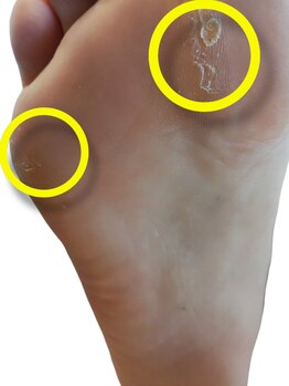 フットケアサロン ラビフット(Rabbi foot)/タコは早目にケアしましょう