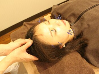 あいのて 国立店/☆リフトアップ美容鍼プレミアム