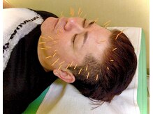 レガロ/美容鍼　男性も大歓迎です♪