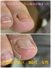 巻き爪じゅん 千葉駅前店/巻き爪自分で切ったら余計に痛い