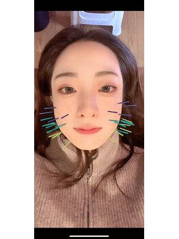 ハリトマト 梅田中崎/施術(肌荒れ・くすみ)