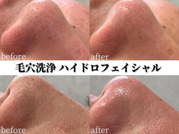 ディオン ケアナ 博多店(Dion)/毛穴洗浄ビフォーアフター