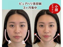 ピュアハリ/沖縄美容鍼/たるみ/効果