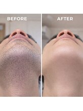 ヨハク(YOHAKU)/20代後半　男性　９回施術