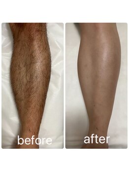 ナチュレオン(Nachuleon)/脱毛は早い方がお得