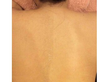 ももとゆでたまご/背中シェービングbefore→after