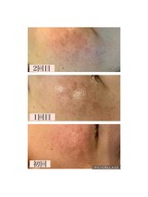 ハピエスト 田辺店/水光肌ピーリング