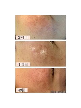 ハピエスト 田辺店/水光肌ピーリング