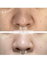 アトワ(A toi)/鼻の毛穴、黒ずみ毛穴