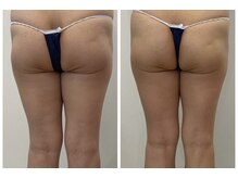 レミュ(Remu)/お尻の形も変わる