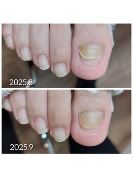 【欠損爪の育爪】