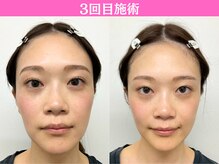 ナチュラルパーフェクトフェイス 新宿/3回目施術