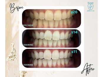 キラット 高知中万々店(Kiratt)/【クリスタルホワイトニング】