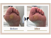 巻き爪補正店 錦糸町店/【タコ・魚の目ケア】