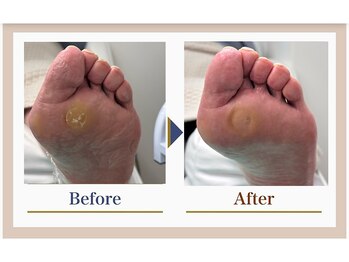 巻き爪補正店 錦糸町店/【タコ・魚の目ケア】