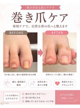 モモナ/巻き爪ケアで自然な爪の形へ