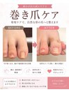 巻き爪ケアで自然な爪の形へ