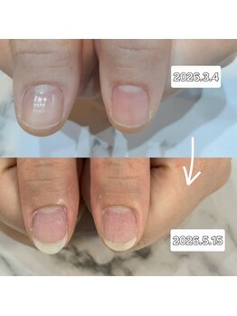 サロン ド コロレ/深爪矯正開始から3か月のお客様